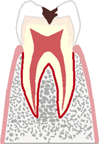 象牙質に達する虫歯