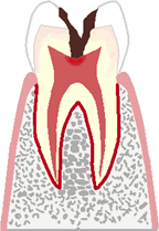 歯髄に達する虫歯