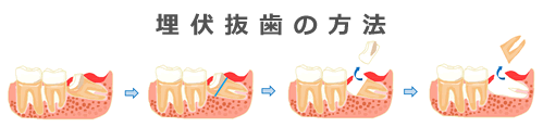 埋伏抜歯の方法