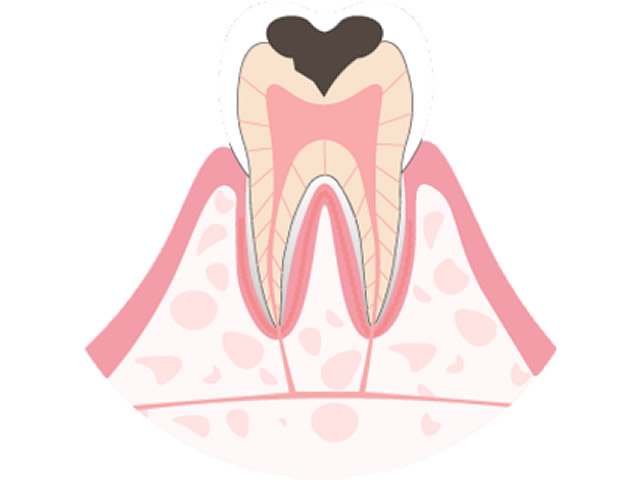 C2象牙質に達する虫歯