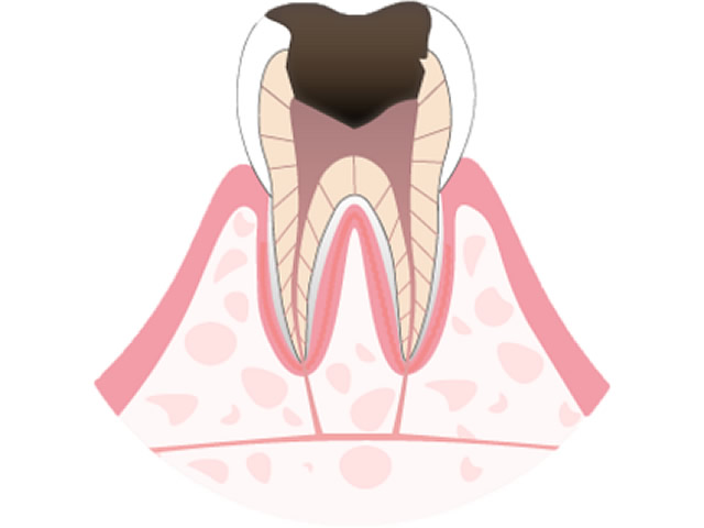 C3歯髄に達する虫歯