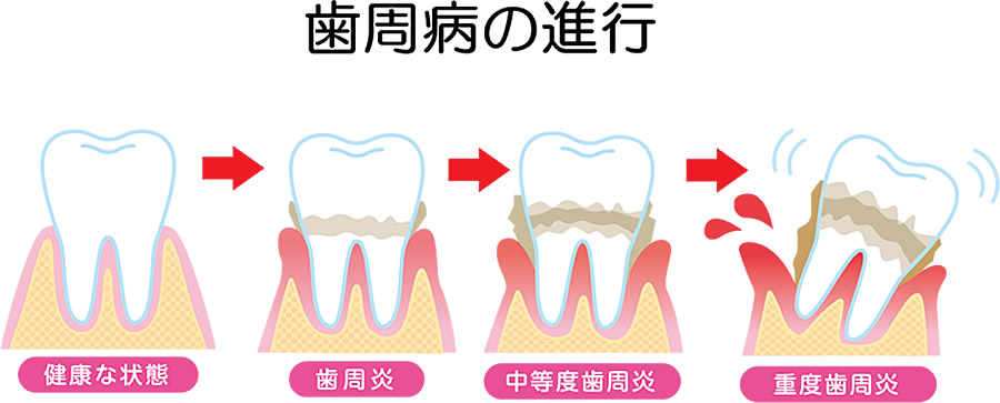 歯周病の治療