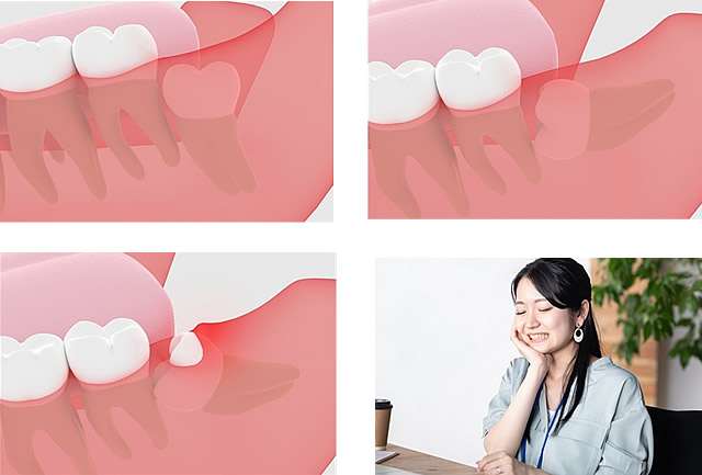 親知らずの治療