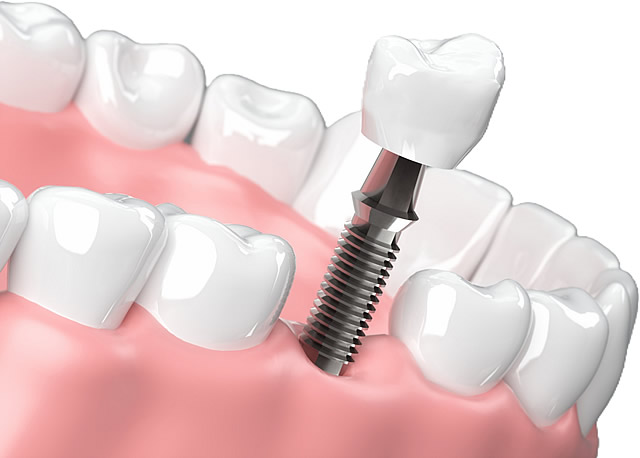 インプラント