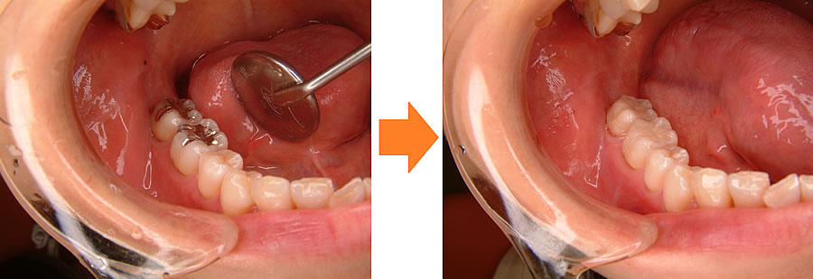 つめもの、かぶせもの
