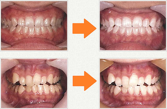 ホワイトニング