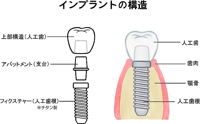 インプラント治療について