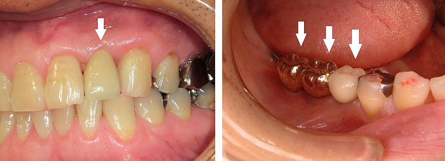 人工歯の成形・装着例